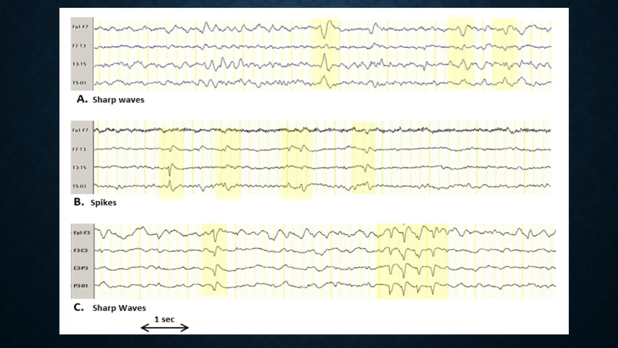 Epileptiform EEG abnormalities in adults and children | PPTX
