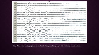 Epileptiform EEG abnormalities in adults and children | PPTX
