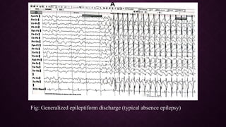 Epileptiform EEG abnormalities in adults and children | PPTX