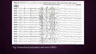 Epileptiform EEG abnormalities in adults and children | PPTX