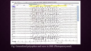 Epileptiform EEG abnormalities in adults and children | PPTX