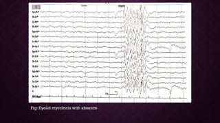 Epileptiform EEG abnormalities in adults and children | PPTX