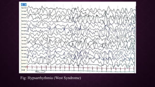 Epileptiform EEG abnormalities in adults and children | PPTX