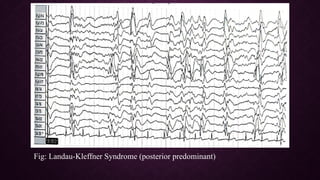 Epileptiform EEG abnormalities in adults and children | PPTX