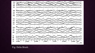 Epileptiform EEG abnormalities in adults and children | PPTX