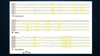 Epileptiform EEG abnormalities in adults and children | PPTX