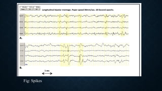 Epileptiform EEG abnormalities in adults and children | PPTX