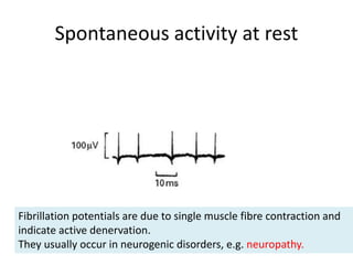 Spontaneous activity at rest
Fibrillation potentials are due to single muscle fibre contraction and
indicate active denervation.
They usually occur in neurogenic disorders, e.g. neuropathy.
 