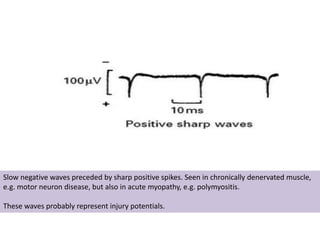 Slow negative waves preceded by sharp positive spikes. Seen in chronically denervated muscle,
e.g. motor neuron disease, but also in acute myopathy, e.g. polymyositis.
These waves probably represent injury potentials.
 