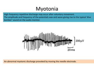 Myotonia
High frequency repetitive discharge may occur after voluntary movement.
The amplitude and frequency of the potentials wax and wane giving rise to the typical ‘dive
bomber’ sound on the audio monitor.
An abnormal myotonic discharge provoked by moving the needle electrode.
 