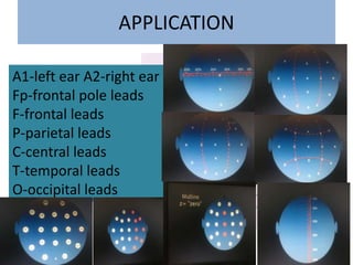 APPLICATION
A1-left ear A2-right ear
Fp-frontal pole leads
F-frontal leads
P-parietal leads
C-central leads
T-temporal leads
O-occipital leads
 