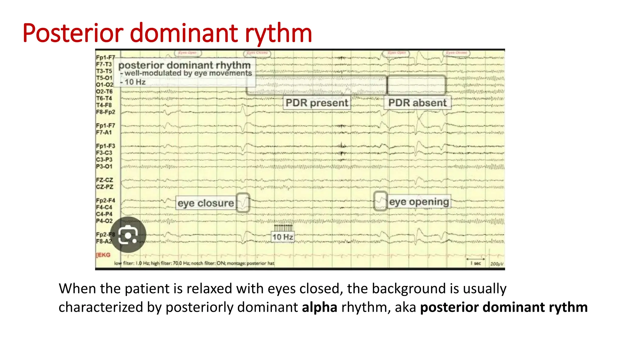 eeg ppt defining all aspects of eeg and various type of waves seen in ...