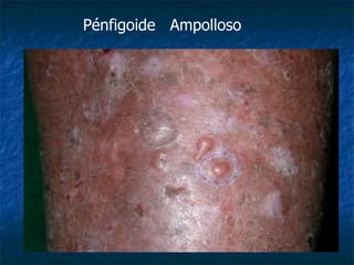 Pénfigoide Ampolloso
 