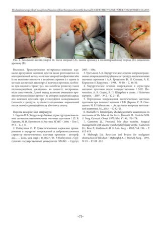 -71-
WschodnioeuropejskieCzasopismoNaukowe(EastEuropeanScientificJournal)|NAUKIMEDYCZNEINAUKIOZDROWIU#IІІ,2015
Рис. 4. Загальний вигляд хворої Ш. після операції (А), заміна дренажу в післяопераційному періоді (Б), видалення
дренажу (В).
Висновки. Транспечінкове внутрішньо-зовнішнє кар-
касне дренування жовчних проток може розглядатися як
альтернативний метод, коли інші операції неефективні або
їх не можливо виконати з технічних причин і є одним із
методів достатньої декомпресії жовчних протоків, особли-
во при високих стриктурах, що запобігає розвитку таких
післяопераційних ускладнень, як холангіт, неспромож-
ність анастомозів. Даний метод дозволяє зменшити про-
яви печінкової недостатності та створює жорсткий каркас
для жовчних протоків при стенозуючих захворюваннях
(холангіт, стриктури, пухлини) та відновлює нормальний
пасаж жовчі в дванадцятипалу або тонку кишку.
Перелік використаної літератури:
1. Гарелік П.В. Хирургия рубцовых стриктур проксималь-
ных сегментов внепеченочных желчных протоков / П. В.
Гарелик, Н. И. Батвинков // Вестник ВГМУ. – 2008. – Том 7,
№ 3. – С. 1-8.
2. Набиуллин И. Р. Транспеченочное каркасное дрени-
рование в хирургии повреждений и доброкачественных
стриктур внепеченочных желчных протоков : автореф.
дис.. … канд. мед. наук : 14.00.27 / И. Р. Набиуллин ; Сур-
гутский государственный университет ХМАО. – Сургут,
2005. – 108с.
3. Третьяков А.А. Хирургическое лечение интраопераци-
онных повреждений и рубцовых стриктур внепеченочных
желчных протоков / А.А. Третьяков, Н. И. Слепых, А. К.
Корнилов // Хирургия. – 1998. - № 10. – С. 46-50.
4. Хирургическое лечение повреждения и стриктуры
желчных протоков после холецистэктомии / М.Е. Ни-
читайло, А. В. Скумс, В. П. Шкарбан и соавт. // Клінічна
хірургія. – 2007. - № 2. – С. 21-25.
5. Ятрогенные повреждения внепеченочных желчных
протоков при холецистэктомии / В.В. Дарвин, С. В. Они-
щенко, И. Р. Набиуллин. – Актуальные вопросы неотлож-
ной хирургии. М., 2003. – С. 42-45.
6. Bismuth H. Intrahepatic cholangioenteric anastomosis in
carcinoma of the hilus of the liver / Bismuth H., Corlette М.В.
// Surg. Gynecol. Obset. 1975, febr, V 140, 170-178.
7. Cameron J.L. Proximal bile duct tumors. Surgical
management with silastic transhepatie biliary stents / Cameron
J.L., Broc P., Zuidema G.D. // Ann. Surg. - 1982, Vol. 196. – P.
412-419.
8. Myburgh J.A. Resection and bypass for malignant
obstruction of bile duct / Myburgh J.A. // World J. Surg. - 1995,
№ 19. – P. 108 -112.
 