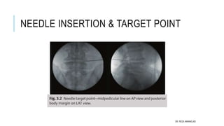 Extraforaminal PELD | PPT