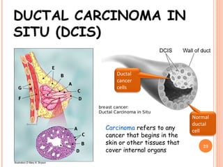 DUCTAL CARCINOMA IN
SITU (DCIS)
Carcinoma refers to any
cancer that begins in the
skin or other tissues that
cover internal organs
23
Illustration © Mary K. Bryson
Ductal
cancer
cells
Normal
ductal
cell
 