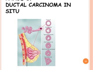 RANGE OF
DUCTAL CARCINOMA IN
SITU
25
Illustration©MaryK.Bryson
 