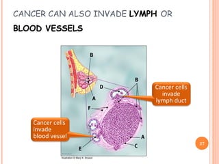 CANCER CAN ALSO INVADE LYMPH OR
BLOOD VESSELS
27
Illustration © Mary K. Bryson
Cancer cells
invade
lymph duct
Cancer cells
invade
blood vessel
 