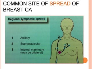 COMMON SITE OF SPREAD OF
BREAST CA
 