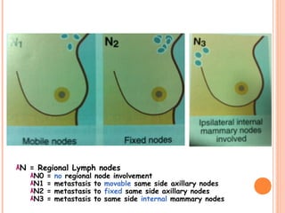N = Regional Lymph nodes
N0 = no regional node involvement
N1 = metastasis to movable same side axillary nodes
N2 = metastasis to fixed same side axillary nodes
N3 = metastasis to same side internal mammary nodes
 