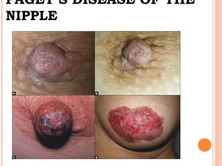 PAGET’S DISEASE OF THE
NIPPLE
 