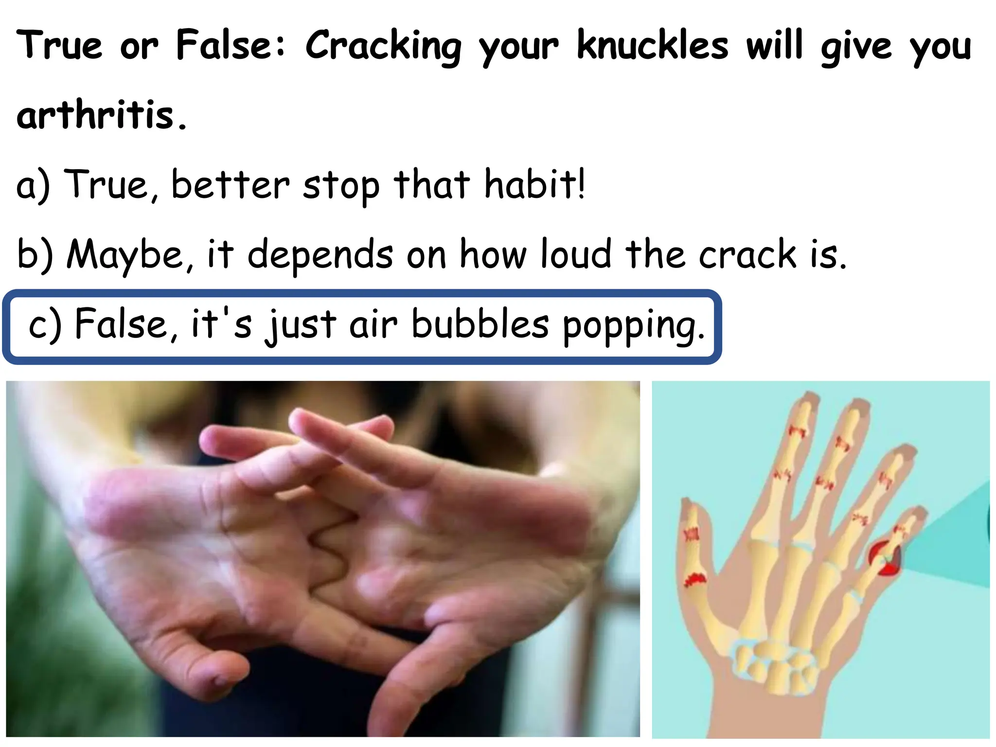 True or False: Cracking your knuckles will give you
arthritis.
a) True, better stop that habit!
b) Maybe, it depends on how loud the crack is.
c) False, it's just air bubbles popping.
 
