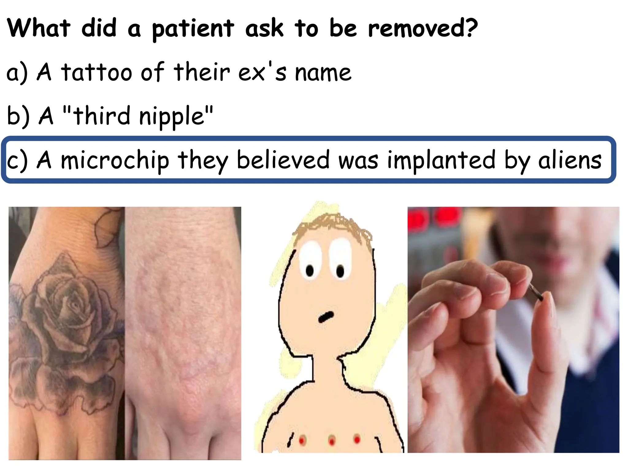 What did a patient ask to be removed?
a) A tattoo of their ex's name
b) A "third nipple"
c) A microchip they believed was implanted by aliens
 