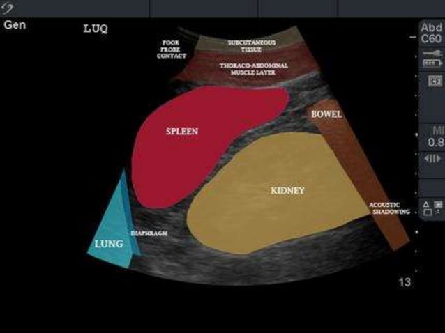 EFAST - A how to guide | PPTX | First Aid | Injuries