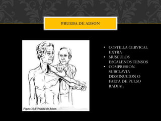 PRUEBA DE ADSON
• COSTILLA CERVICAL
EXTRA
• MUSCULOS
ESCALENOS TENSOS
• COMPRESION
SUBCLAVIA
DISMINUCION O
FALTA DE PULSO
RADIAL
 
