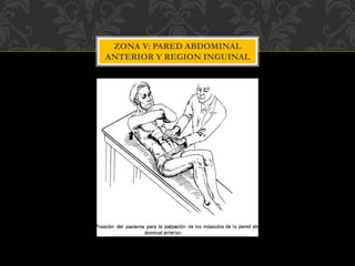 ZONA V: PARED ABDOMINAL
ANTERIOR Y REGION INGUINAL
 