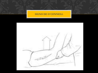 SIGNO DE O`CONNELL
 
