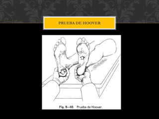 PRUEBA DE HOOVER
 