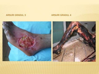 ARSURI GRADUL 3 ARSURI GRADUL 4
 