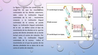 La figura 6 muestra las condiciones de
carga en las que los movimientos
controlados de los dientes anteriores,
tales como la inclinación lingual
controlada de la raíz , movimiento
corporal, y la inclinación lingual
controlada de la corona, se puede
lograr. La inclinación lingual controlada
de la raíz se define como el tipo de
movimiento de los dientes en la que las
puntas del diente alrededor de su borde
incisal como el centro de rotación. Por
otro lado, la inclinación lingual
controlada de la corona indica el
movimiento en el que las puntas de los
dientes alrededor de su ápice de la raíz
como el centro de rotación.
 