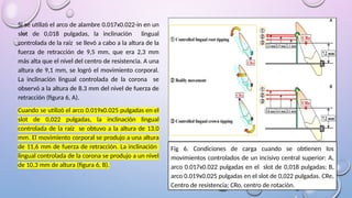 Si se utilizó el arco de alambre 0.017x0.022-in en un
slot de 0,018 pulgadas, la inclinación lingual
controlada de la raíz se llevó a cabo a la altura de la
fuerza de retracción de 9,5 mm, que era 2,3 mm
más alta que el nivel del centro de resistencia. A una
altura de 9,1 mm, se logró el movimiento corporal.
La inclinación lingual controlada de la corona se
observó a la altura de 8.3 mm del nivel de fuerza de
retracción (figura 6, A).
Cuando se utilizó el arco 0.019x0.025 pulgadas en el
slot de 0,022 pulgadas, la inclinación lingual
controlada de la raíz se obtuvo a la altura de 13.0
mm. El movimiento corporal se produjo a una altura
de 11,6 mm de fuerza de retracción. La inclinación
lingual controlada de la corona se produjo a un nivel
de 10,3 mm de altura (figura 6, B).
Fig 6. Condiciones de carga cuando se obtienen los
movimientos controlados de un incisivo central superior: A,
arco 0.017x0.022 pulgadas en el slot de 0,018 pulgadas; B,
arco 0.019x0.025 pulgadas en el slot de 0,022 pulgadas. CRe,
Centro de resistencia; CRo, centro de rotación.
 