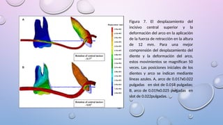 Figura 7. El desplazamiento del
incisivo central superior y la
deformación del arco en la aplicación
de la fuerza de retracción en la altura
de 12 mm. Para una mejor
comprensión del desplazamiento del
diente y la deformación del arco,
estos movimientos se magnifican 50
veces. Las posiciones iniciales de los
dientes y arco se indican mediante
líneas azules. A, arco de 0.017x0.022
pulgadas en slot de 0.018 pulgadas;
B, arco de 0.019x0.025 pulgadas en
slot de 0.022pulgadas.
 