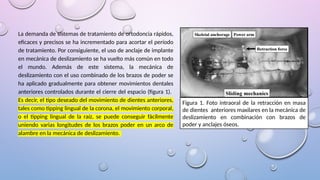 La demanda de sistemas de tratamiento de ortodoncia rápidos,
eficaces y precisos se ha incrementado para acortar el período
de tratamiento. Por consiguiente, el uso de anclaje de implante
en mecánica de deslizamiento se ha vuelto más común en todo
el mundo. Además de este sistema, la mecánica de
deslizamiento con el uso combinado de los brazos de poder se
ha aplicado gradualmente para obtener movimientos dentales
anteriores controlados durante el cierre del espacio (figura 1).
Es decir, el tipo deseado del movimiento de dientes anteriores,
tales como tipping lingual de la corona, el movimiento corporal,
o el tipping lingual de la raíz, se puede conseguir fácilmente
uniendo varias longitudes de los brazos poder en un arco de
alambre en la mecánica de deslizamiento.
Figura 1. Foto intraoral de la retracción en masa
de dientes anteriores maxilares en la mecánica de
deslizamiento en combinación con brazos de
poder y anclajes óseos.
 