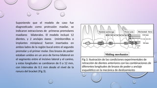 Suponiendo que el modelo de caso fue
diagnosticado como protrusión maxilar, se
indicaron extracciones de primeras premolares
maxilares bilaterales. El modelo incluyó 12
dientes, y 2 anclajes óseos (minitornillos o
implantes miniplaca) fueron insertados en
ambos lados de la región bucal entre el segundo
premolar y el primer molar. Dos brazos de poder
estaban unidos en un arco de forma bilateral en
el segmento entre el incisivo lateral y el canino,
y estas longitudes se cambiaron de 0 a 12 mm,
con intervalos de 0.1 mm desde el nivel de la
ranura del bracket (Fig 3).
Fig 3. Ilustración de las condiciones experimentales de
retracción de dientes anteriores con las combinaciones de
diferentes longitudes de brazos de poder y anclaje
esquelético en la mecánica de deslizamiento
 