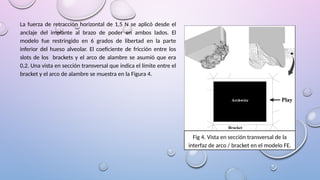 La fuerza de retracción horizontal de 1,5 N se aplicó desde el
anclaje del implante al brazo de poder en ambos lados. El
modelo fue restringido en 6 grados de libertad en la parte
inferior del hueso alveolar. El coeficiente de fricción entre los
slots de los brackets y el arco de alambre se asumió que era
0,2. Una vista en sección transversal que indica el límite entre el
bracket y el arco de alambre se muestra en la Figura 4.
Fig 4. Vista en sección transversal de la
interfaz de arco / bracket en el modelo FE.
 
