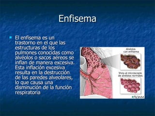 Enfisema El enfisema es un trastorno en el que las estructuras de los pulmones conocidas como alvéolos o sacos aéreos se inflan de manera excesiva. Esta inflación excesiva resulta en la destrucción de las paredes alveolares, lo que causa una disminución de la función respiratoria  