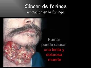 Cáncer de faringe irritación en la faringe 