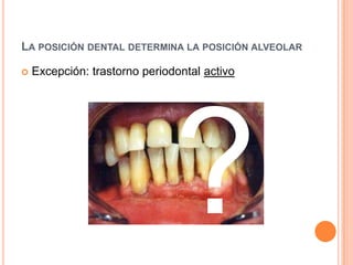 LA POSICIÓN DENTAL DETERMINA LA POSICIÓN ALVEOLAR

   Excepción: trastorno periodontal activo
 