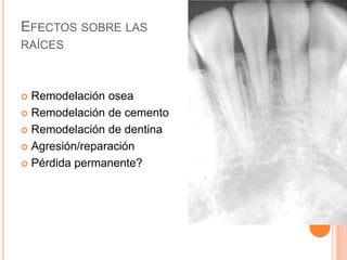 EFECTOS SOBRE LAS
RAÍCES



 Remodelación osea
 Remodelación de cemento

 Remodelación de dentina

 Agresión/reparación

 Pérdida permanente?
 