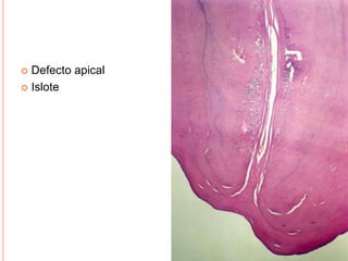  Defecto apical
 Islote
 