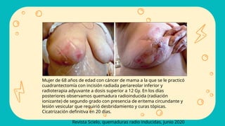 Mujer de 68 años de edad con cáncer de mama a la que se le practicó
cuadrantectomía con incisión radiada periareolar inferior y
radioterapia adyuvante a dosis superior a 12 Gy. En los días
posteriores observamos quemadura radioinducida (radiación
ionizante) de segundo grado con presencia de eritema circundante y
lesión vesicular que requirió desbridamiento y curas tópicas.
Cicatrización definitiva en 20 días.
Revista Scielo, quemaduras radio inducidas, junio 2020
 