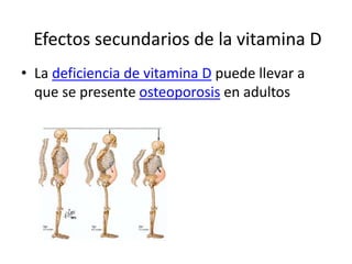 Efectos secundarios de la vitamina D
• La deficiencia de vitamina D puede llevar a
que se presente osteoporosis en adultos
 