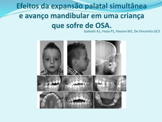 Galeotti A1, Festa P1, Pavone M2, De Vincentiis GC3
Efeitos da expansão palatal simultânea
e avanço mandibular em uma criança
que sofre de OSA.
 