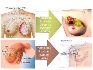 Contoh (2)
Karsinoma
kuadran
dalam ke
mamaria
interna

Karsinoma
kuadran
luar ke
ketiak

 