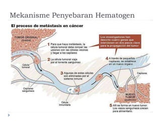 Mekanisme Penyebaran Hematogen

 