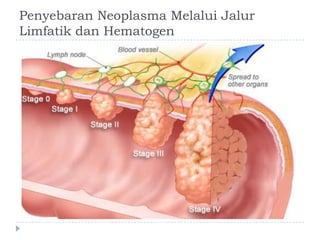 Penyebaran Neoplasma Melalui Jalur
Limfatik dan Hematogen

 